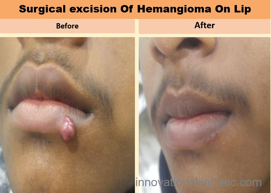 Surgeries For Benign Skin - Hemangioma On Lip